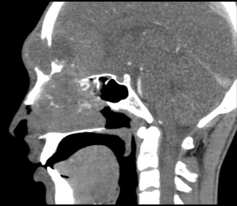 CT Head and Neck (Saggital) of the tumor, originating from the nasopharynx, extending into the cranium